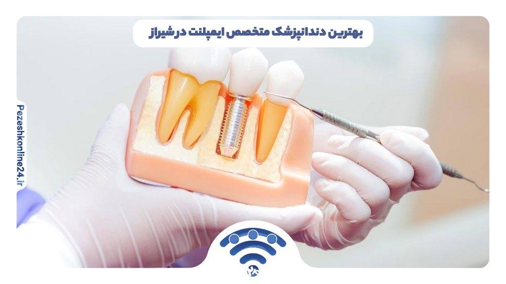 ۷ بهترین دندانپزشک ایمپلنت دندان در شیراز ❤️