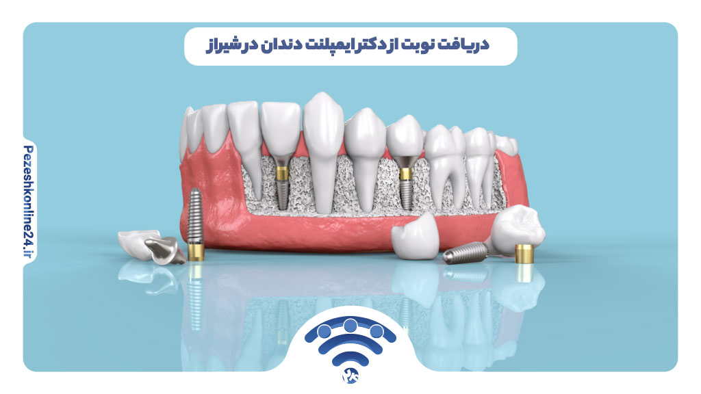 ایمپلنت دندان در شیراز 