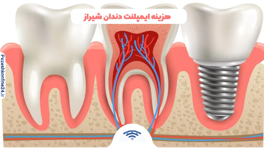 هزینه ایمپلنت دندان شیراز