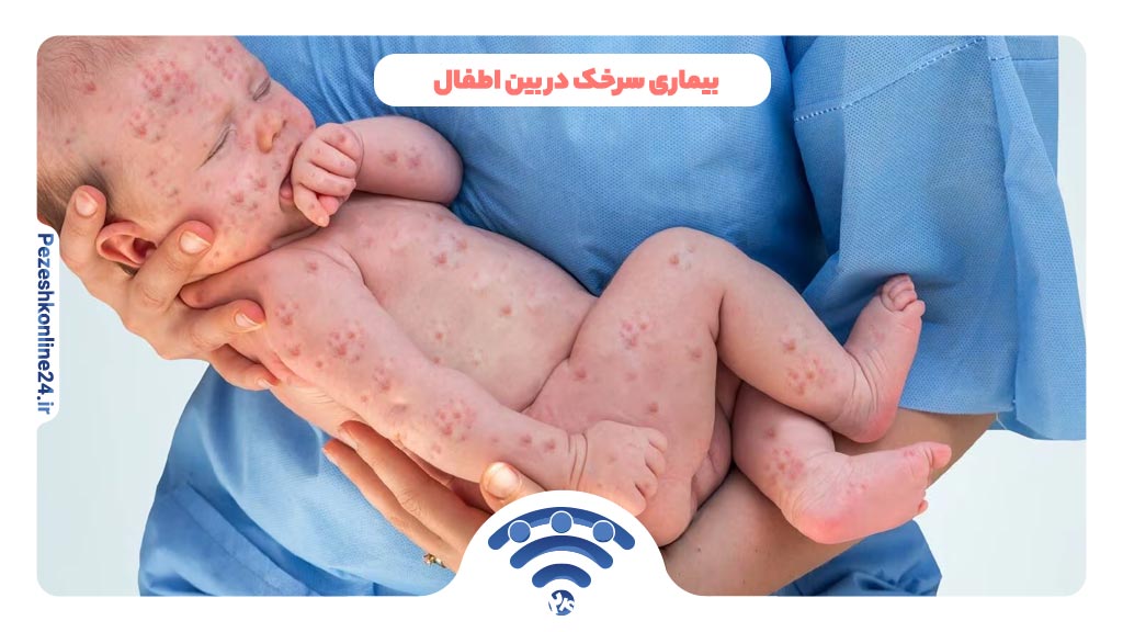 بیماری سرخک در بین اطفال