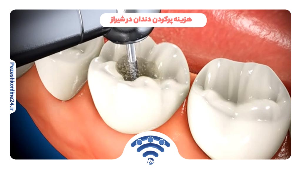 هزینه پرکردن دندان در شیراز