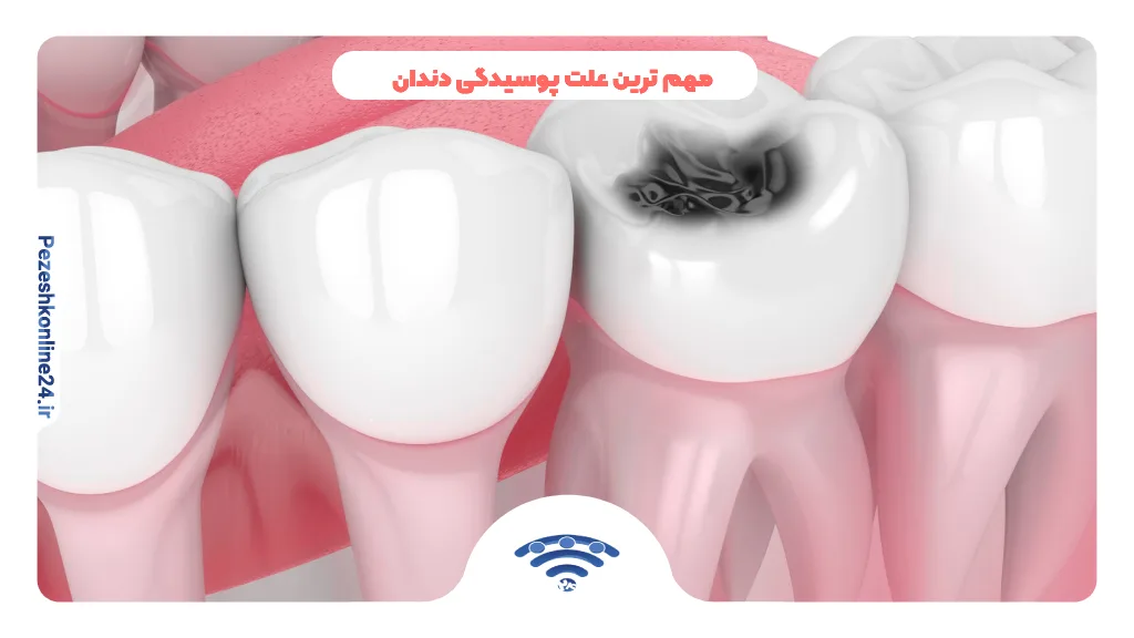 مهم ترین علت پوسیدگی دندان