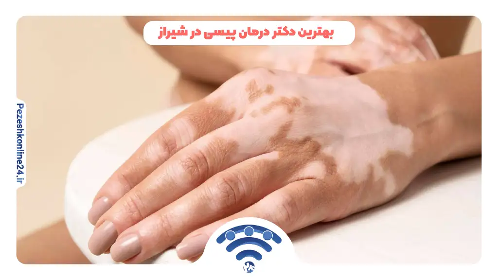 درمان پیسی در شیراز