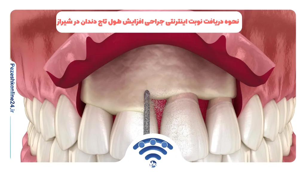 نحوه دریافت نوبت اینترنتی جراحی افزایش طول تاج دندان در شیراز