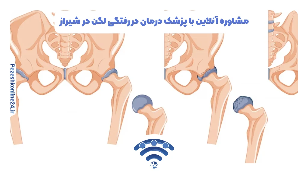 مشاوره آنلاین با پزشک درمان دررفتگی لگن در شیراز