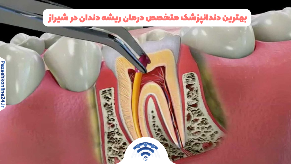 بهترین دندانپزشک متخصص درمان ریشه دندان در شیراز – سال ۱۴۰۳