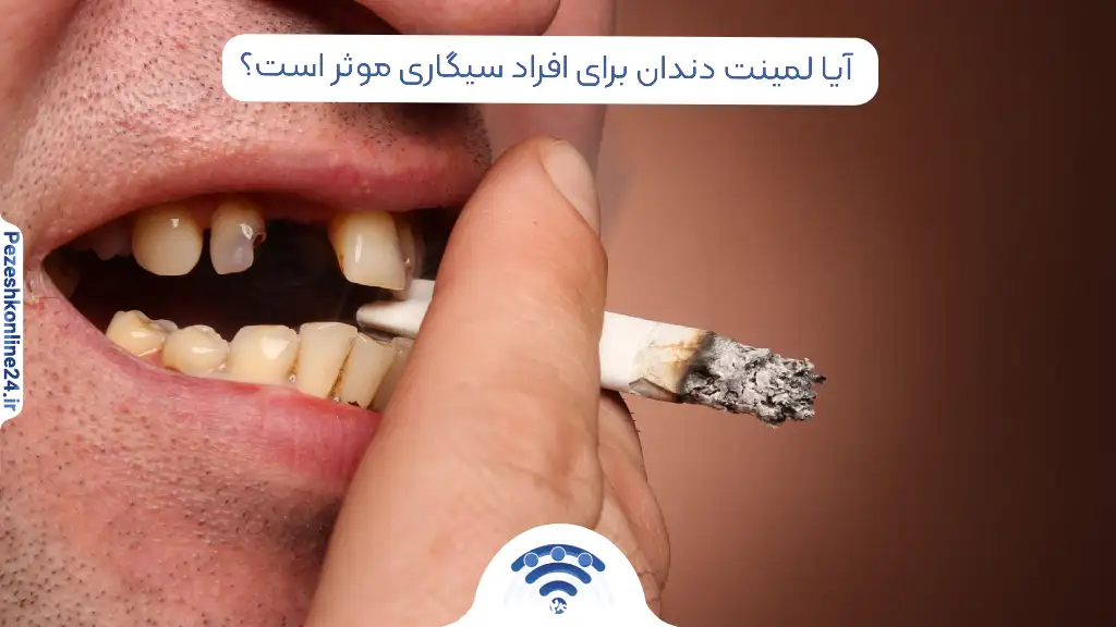 آیا لمینت دندان برای افراد سیگاری موثر است؟
