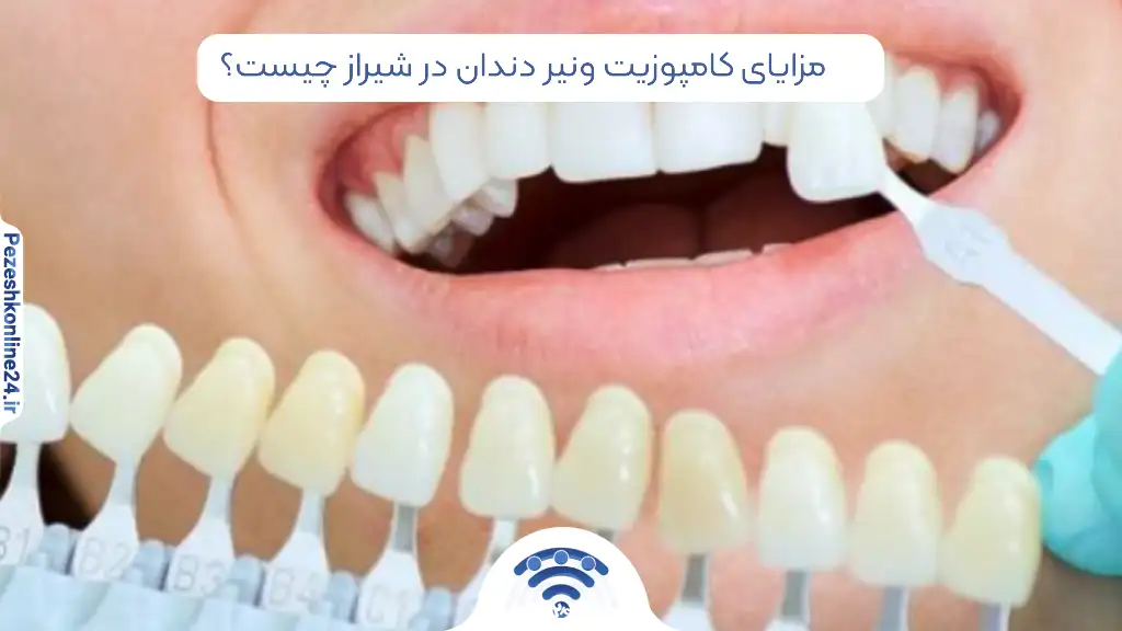 مزایای کامپوزیت ونیر دندان در شیراز چیست؟