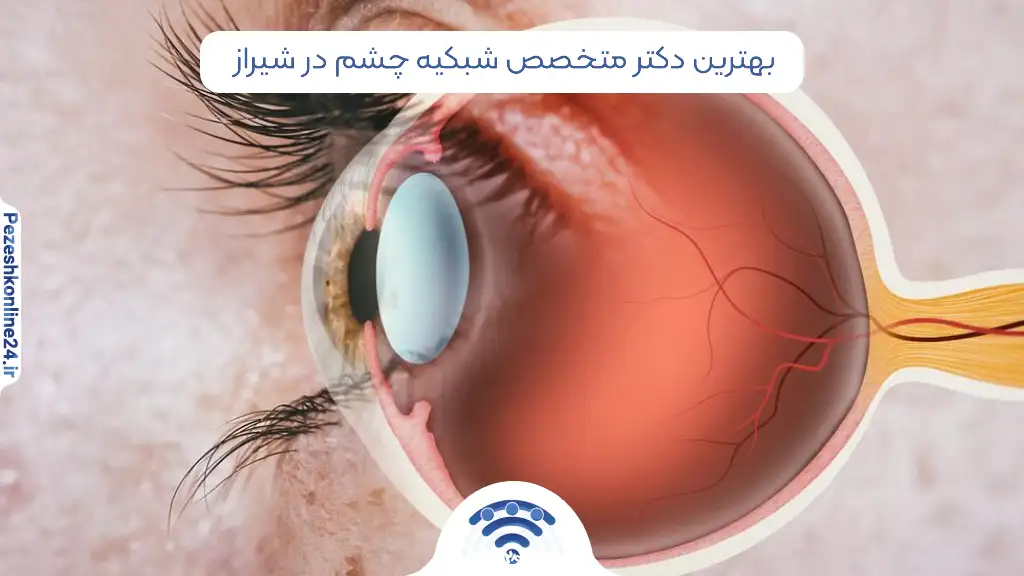بهترین دکتر متخصص شبکیه چشم در شیراز