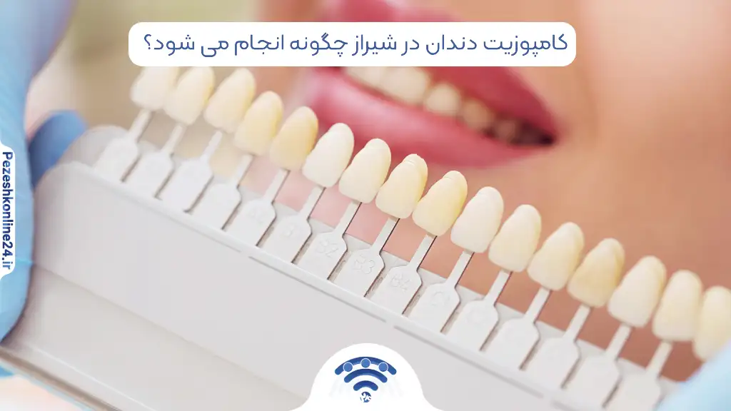 کامپوزیت دندان در شیراز چگونه انجام می‌ شود؟