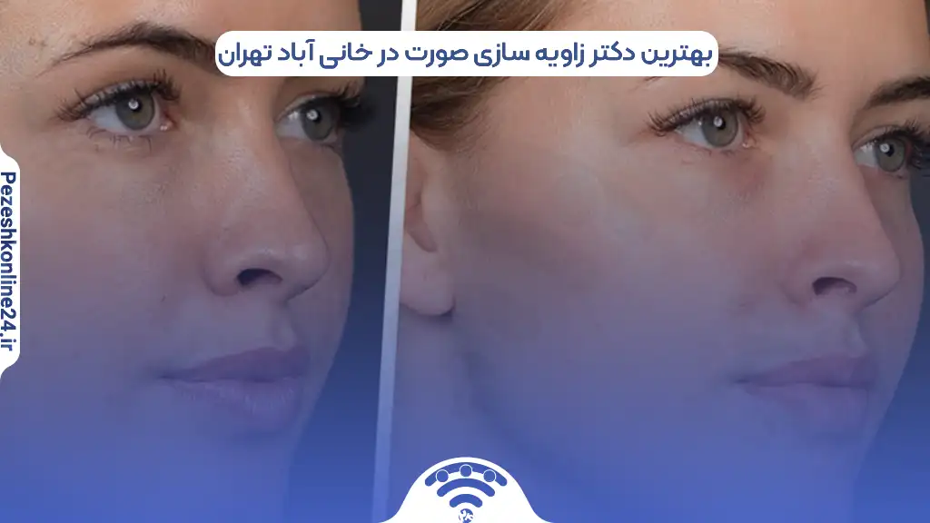 بهترین دکتر زاویه سازی صورت در خانی آباد تهران