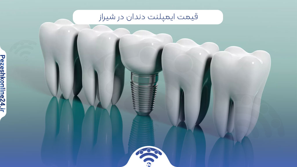 قیمت ایمپلنت دندان در شیراز