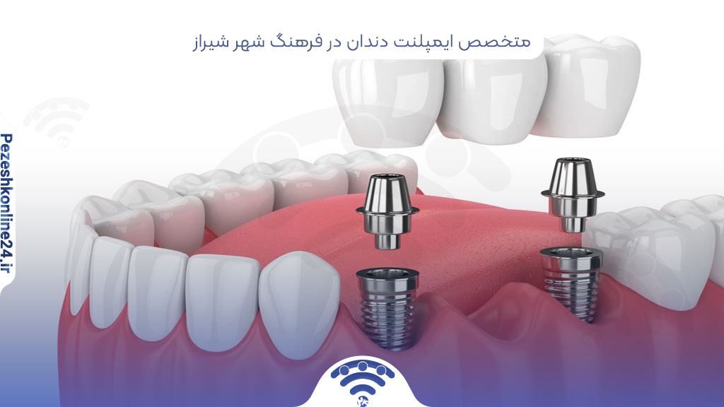 متخصص ایمپلنت دندان در فرهنگ شهر شیراز