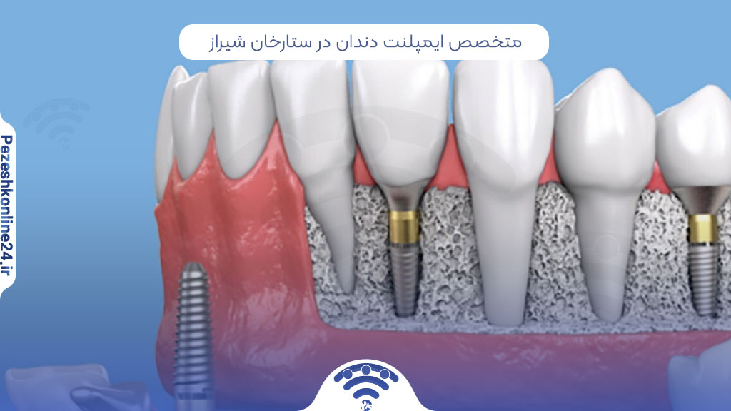 متخصص ایمپلنت دندان در ستارخان شیراز