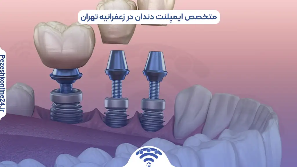 متخصص ایمپلنت دندان در زعفرانیه تهران