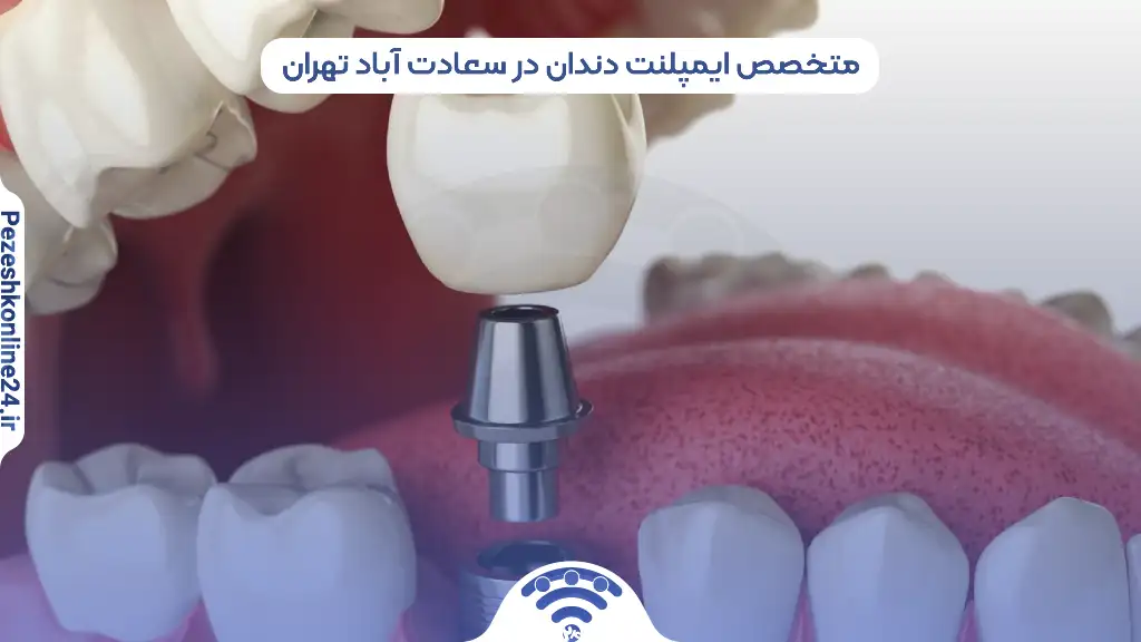 ایمپلنت دندان در سعادت آباد تهران