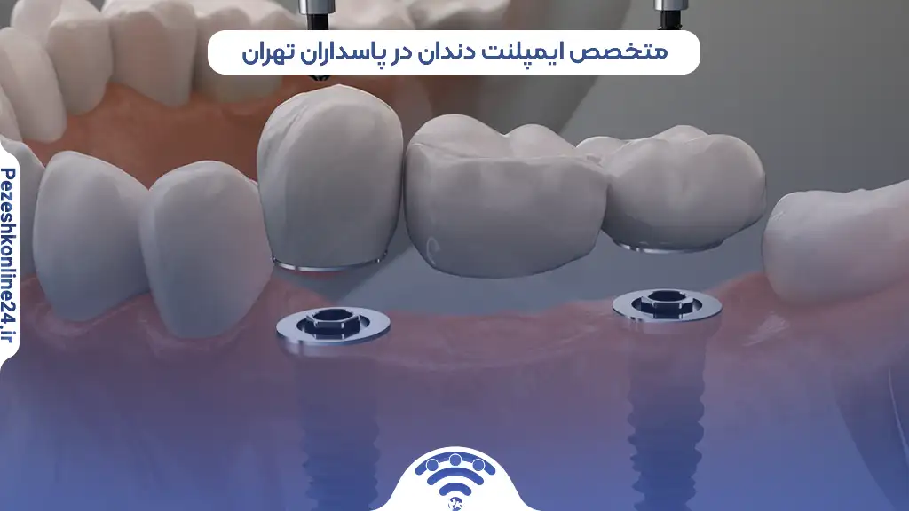 ایمپلنت دندان در پاسداران تهران