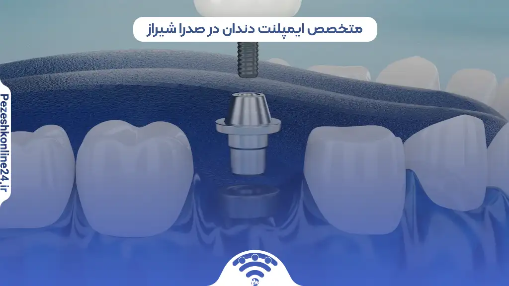 ایمپلنت دندان در صدرا شیراز