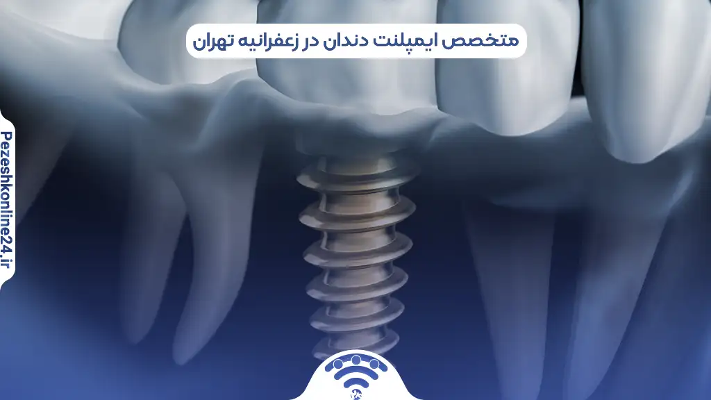 ایمپلنت دندان در زعفرانیه تهران