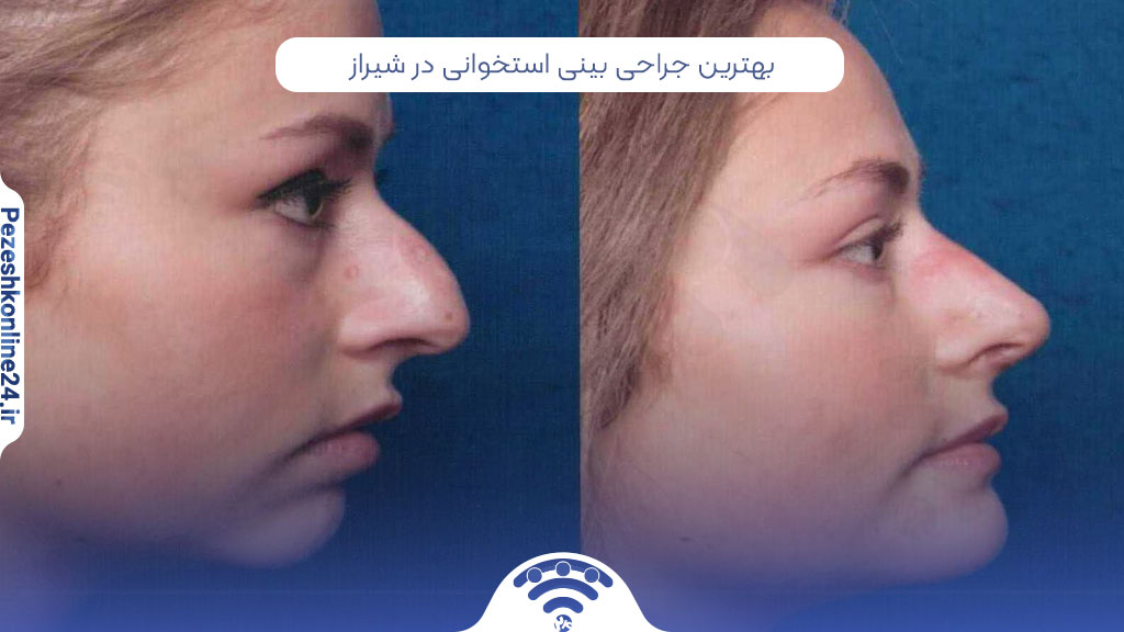 ۵ بهترین جراحی بینی استخوانی در شیراز