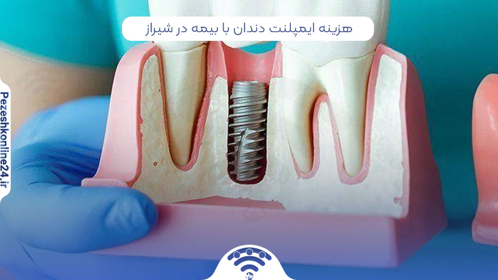 هزینه ایمپلنت دندان با بیمه در شیراز