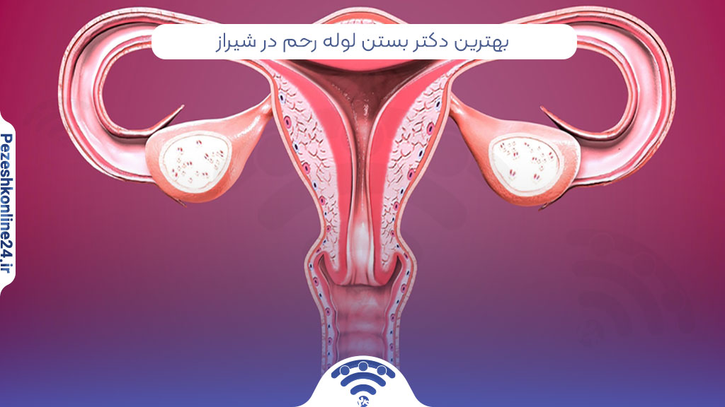بهترین دکتر بستن لوله رحم در شیراز