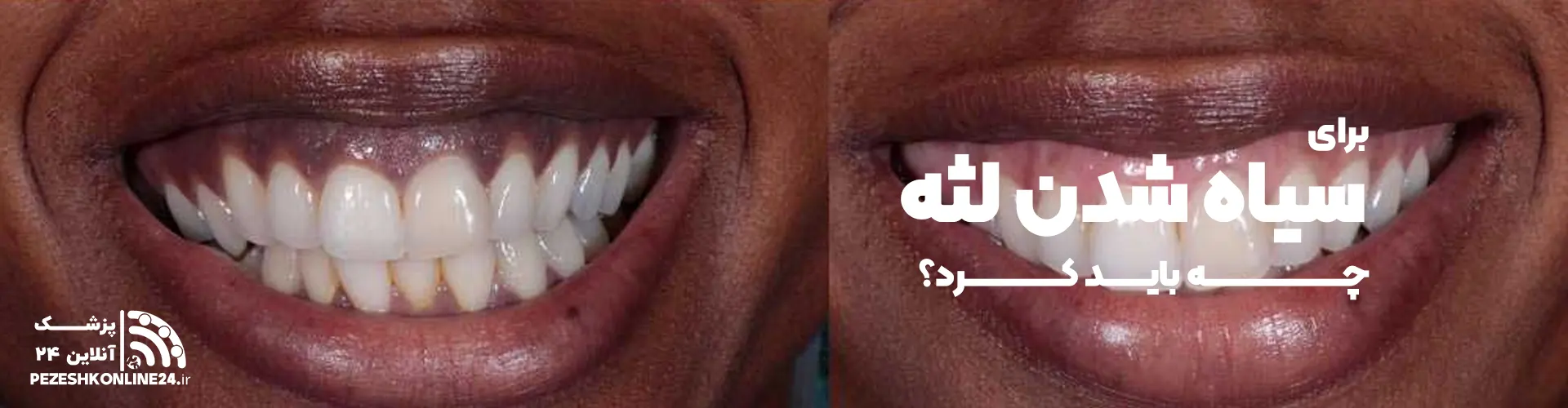 برای سیاه شدن لثه چه باید کرد؟